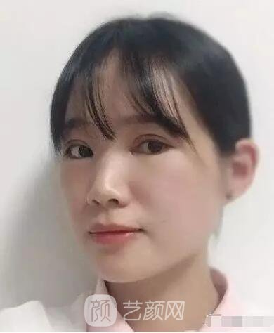 王紅敏切開雙眼皮+開內(nèi)眼角圖術后心情小述