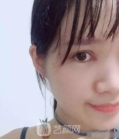 王紅敏切開雙眼皮+開內(nèi)眼角圖術后心情小述