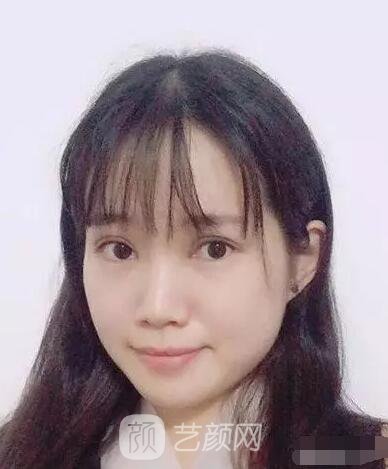 王紅敏切開雙眼皮+開內(nèi)眼角圖術后心情小述