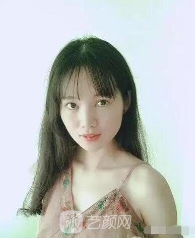 王紅敏切開雙眼皮+開內(nèi)眼角圖術后心情小述