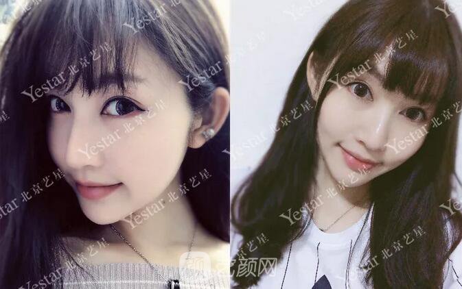 北京藝星整形醫(yī)院注射瘦臉￥499 | 打完半個(gè)月，來看看果!