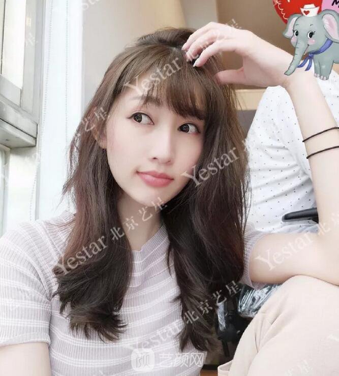 北京藝星整形醫(yī)院注射瘦臉￥499 | 打完半個(gè)月，來看看果!