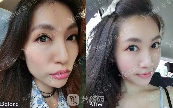 北京藝星整形醫(yī)院注射瘦臉￥499 | 打完半個(gè)月，來看看果!