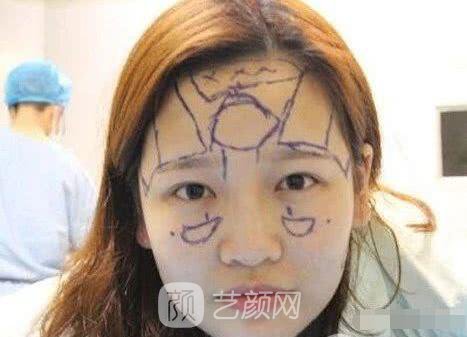 艾紅梅面部自體脂肪填充手術(shù)圖心情分享