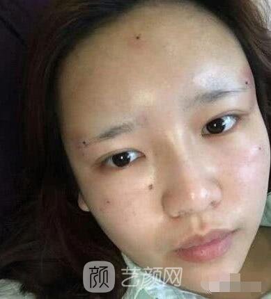 艾紅梅面部自體脂肪填充手術(shù)圖心情分享