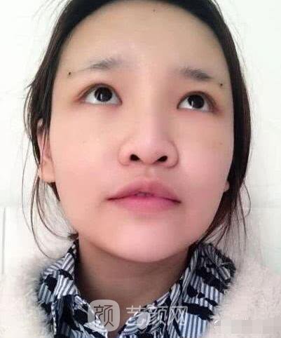 艾紅梅面部自體脂肪填充手術(shù)圖心情分享