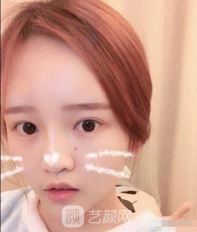 艾紅梅面部自體脂肪填充手術(shù)圖心情分享