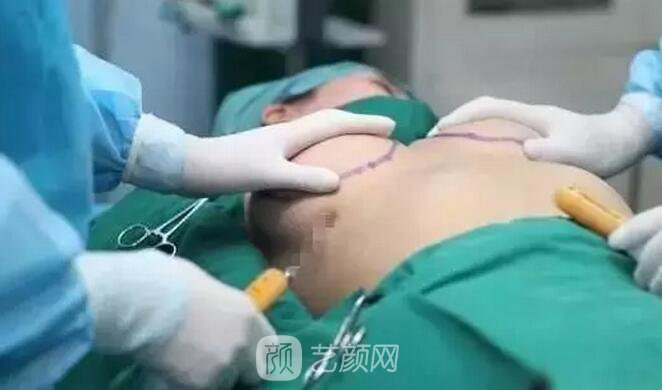 惠州伊麗莎白整形醫(yī)院自體脂肪豐胸圖 豐胸圖鑒