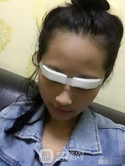 萍鄉(xiāng)優(yōu)美整形李清芳全切雙眼皮照片 拯救眼睛不對(duì)稱