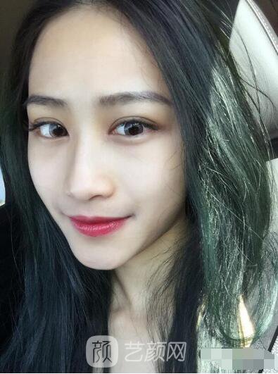 萍鄉(xiāng)優(yōu)美整形李清芳全切雙眼皮照片 拯救眼睛不對(duì)稱