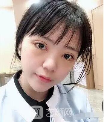 上海伊美爾港華醫(yī)院開雙眼皮圖 大小眼的救星