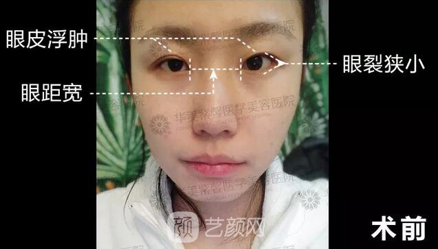 成都華美紫馨平行雙眼皮真人案例反饋照片