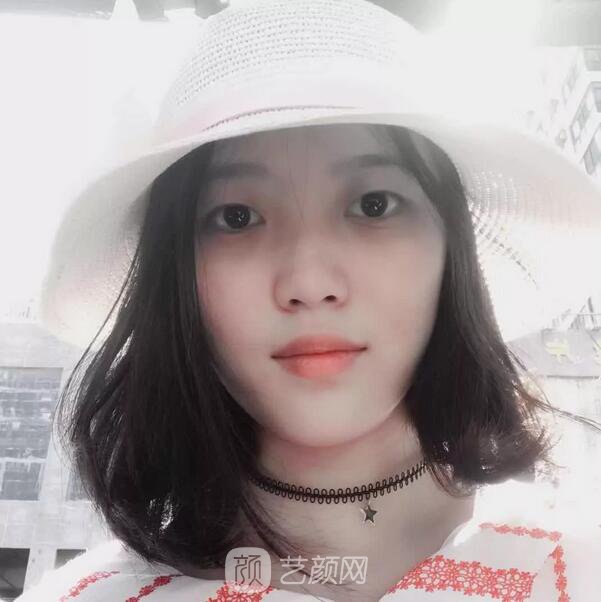 北京西美整形醫(yī)院全切雙眼皮真人案例圖|內(nèi)附恢復(fù)過(guò)程哦~