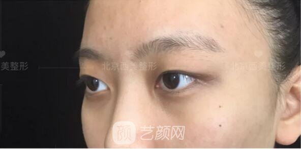 北京西美整形醫(yī)院全切雙眼皮真人案例圖|內(nèi)附恢復(fù)過(guò)程哦~