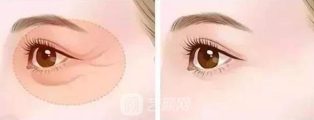 北京藝星整形Yestar分齡祛眼袋真實案例圖分享哦~