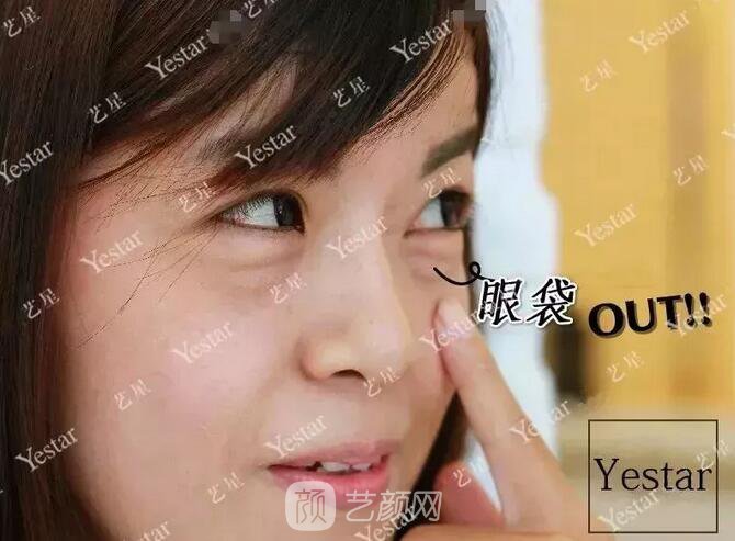 北京藝星整形Yestar分齡祛眼袋真實案例圖分享哦~