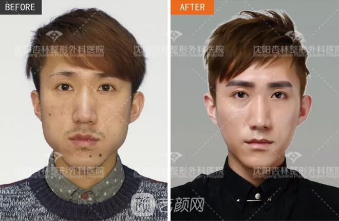 沈陽杏林朱石江三維顴骨縮小術(shù)真人案例圖分享