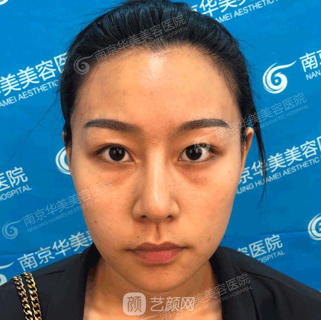 南京華美裴旭芳怎么樣?自體脂肪填充全臉真人案例