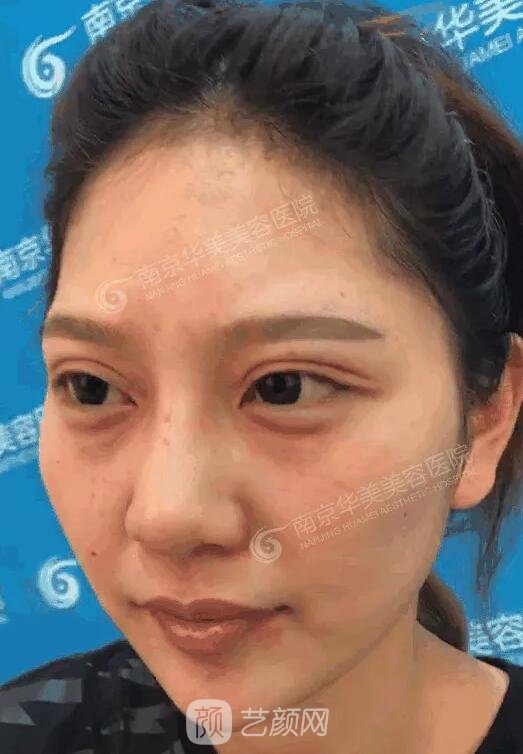 南京華美裴旭芳怎么樣?自體脂肪填充全臉真人案例