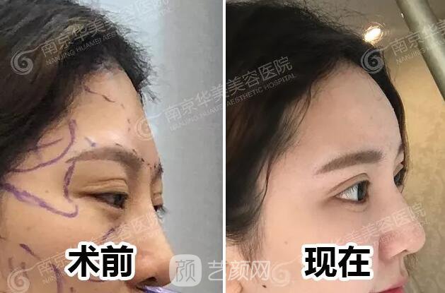 南京華美裴旭芳怎么樣?自體脂肪填充全臉真人案例