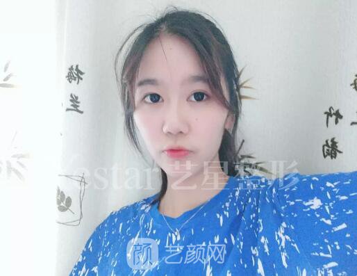 南京藝星割雙眼皮案例半年圖