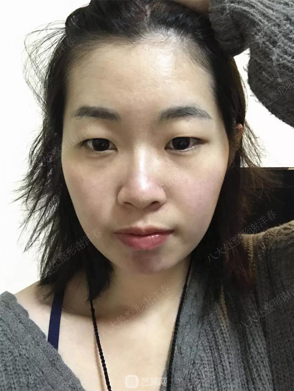 北京八大處割雙眼皮恢復(fù)過(guò)程，內(nèi)附圖