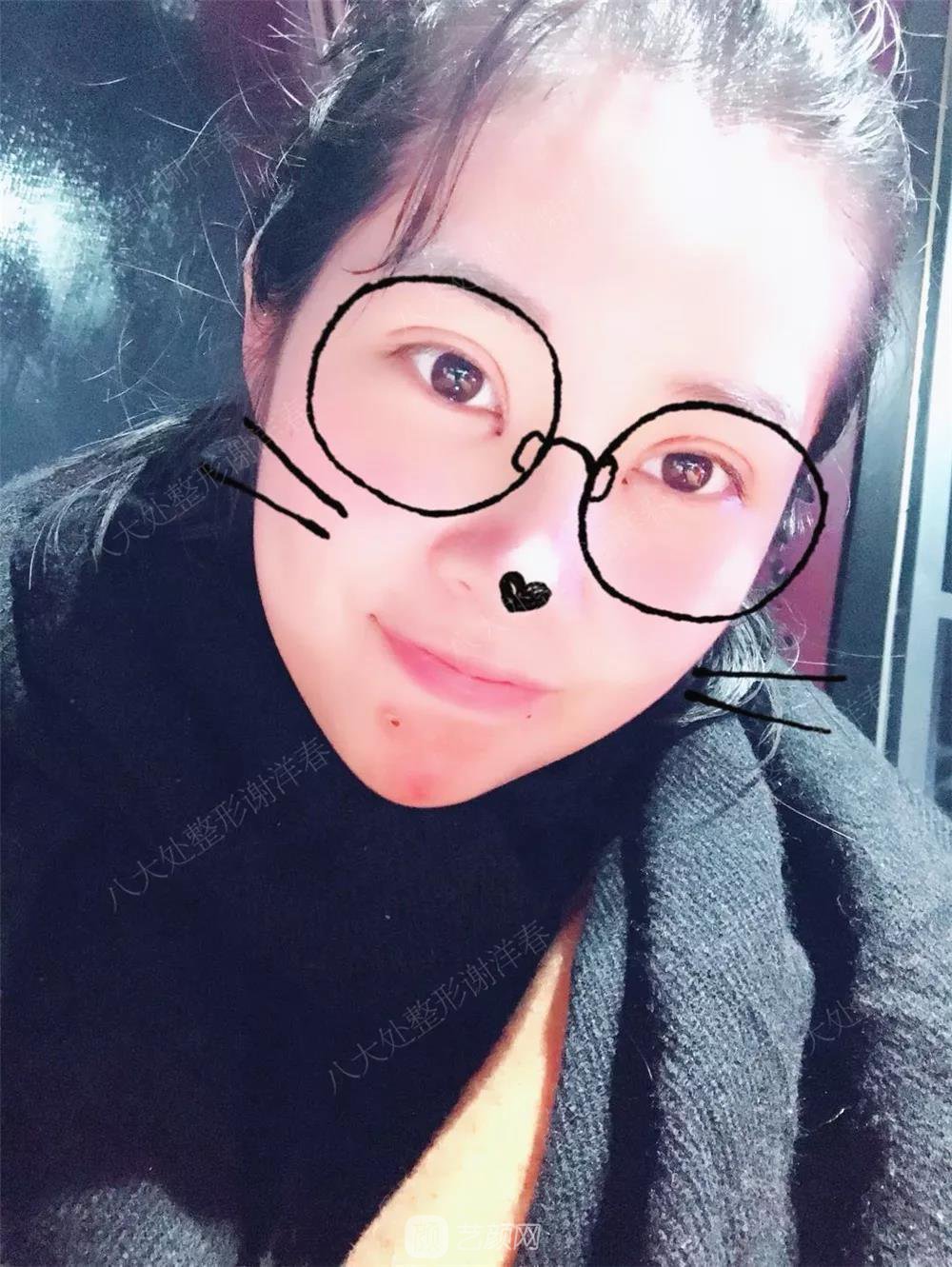 北京八大處割雙眼皮恢復(fù)過(guò)程，內(nèi)附圖