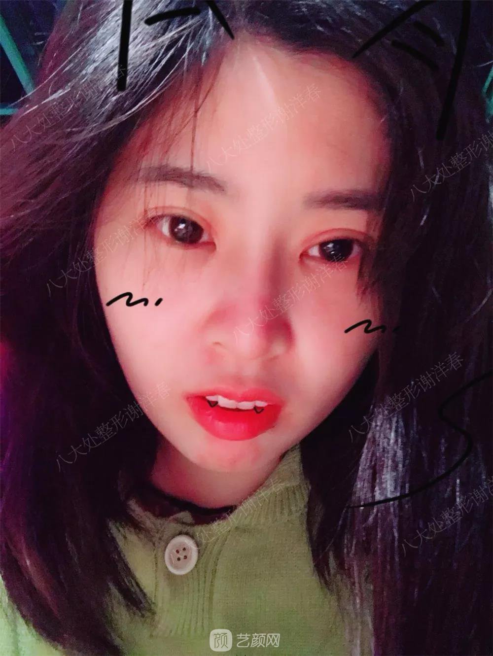 北京八大處割雙眼皮恢復(fù)過(guò)程，內(nèi)附圖