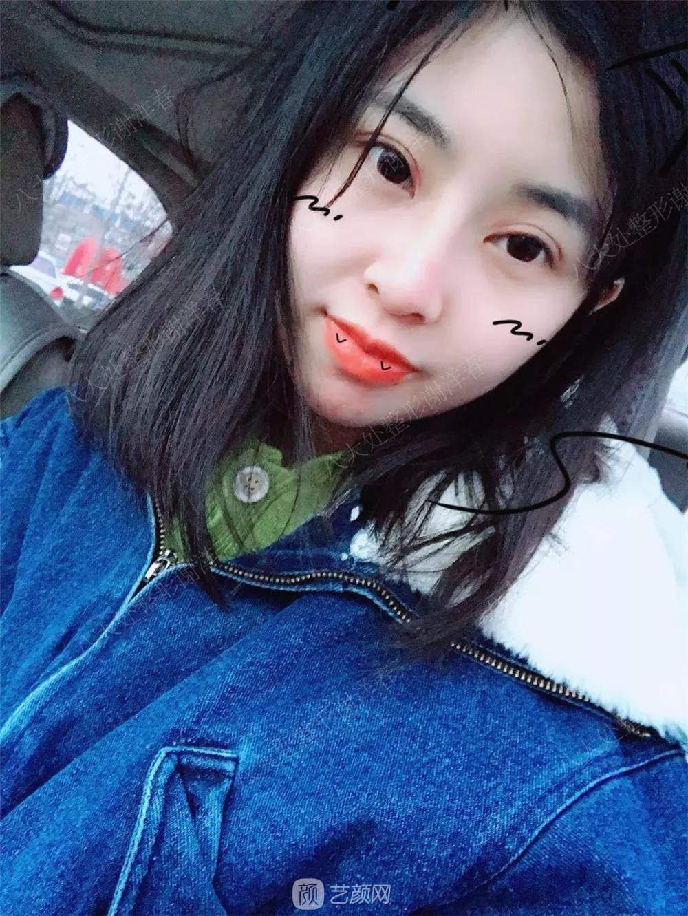 北京八大處割雙眼皮恢復(fù)過(guò)程，內(nèi)附圖