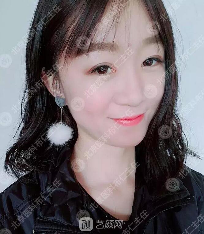 北京八大處整形布仁全切雙眼皮真實(shí)案例|圖