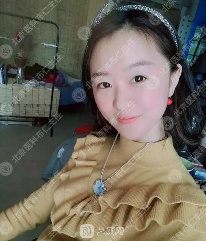 北京八大處整形布仁全切雙眼皮真實(shí)案例|圖