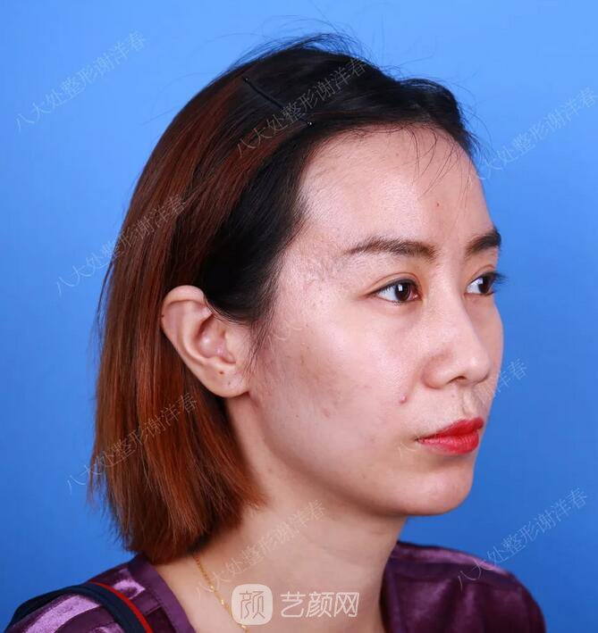 北京八大處面部脂肪填充心形臉真實(shí)案例|照片