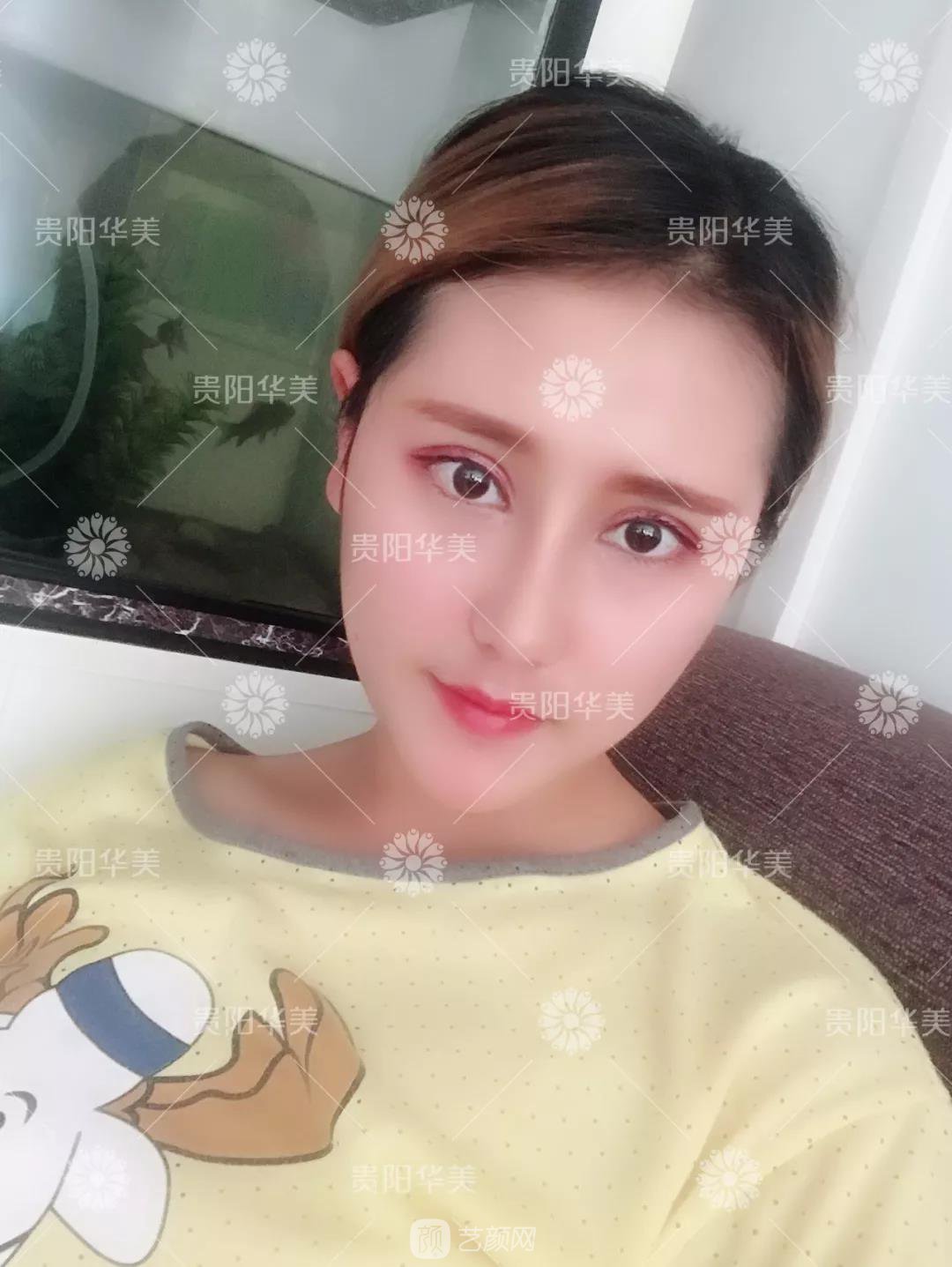 貴陽華美謝占軍割雙眼皮+隆鼻真人案例圖分享