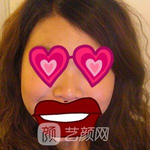 上海華美謝衛(wèi)國(guó)耳軟骨隆