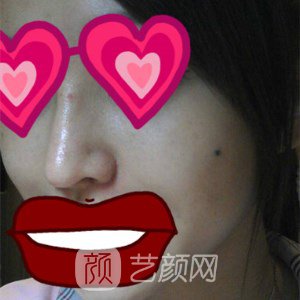 上海華美謝衛(wèi)國(guó)耳軟骨隆