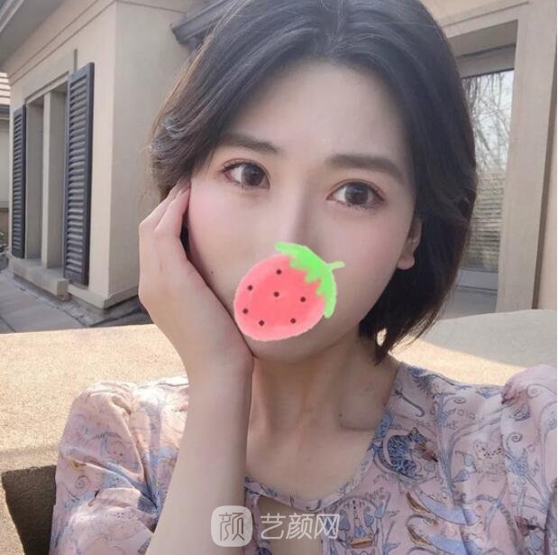 東莞美立方單眼皮割雙眼皮圖|內(nèi)附手術(shù)全程恢復(fù)