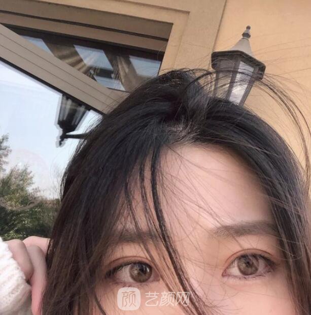 東莞美立方單眼皮割雙眼皮圖|內(nèi)附手術(shù)全程恢復(fù)