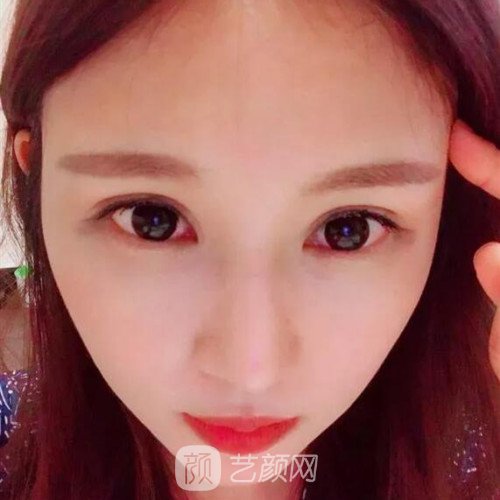 成都銅雀臺(tái)雷剛雙眼皮修復(fù)案例分享，半個(gè)月果圖~