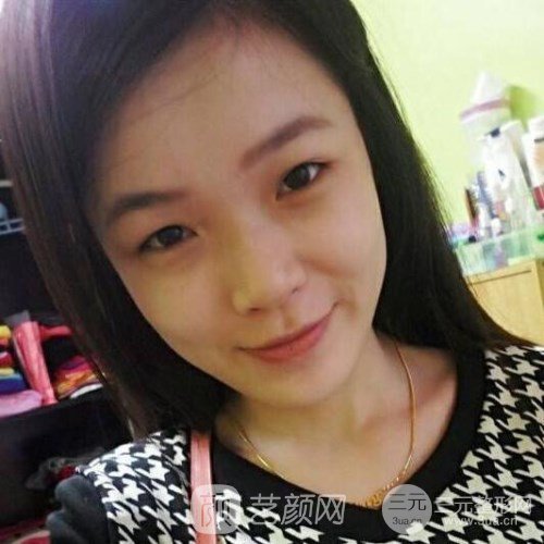 上海華美楊亞益主任做的芭比雙眼皮，果很好哦~