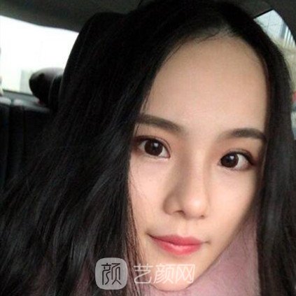 重慶聯(lián)合麗格王巖玻尿酸隆鼻三個(gè)月了，分享果照片~