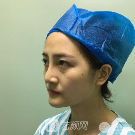 武漢華亞李?lèi)?ài)林自體脂肪面部填充三個(gè)月案例分享~