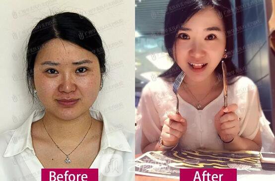 皮-秒激光祛斑案例，恢復(fù)照片分享~