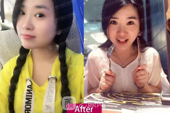 皮-秒激光祛斑案例，恢復(fù)照片分享~