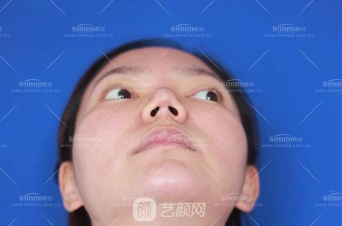 上海喜美全肋鼻修復(fù)+鼻頭縮小+鼻小柱后縮矯正案例~