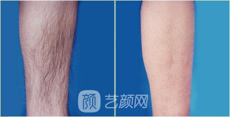 溫州激光脫毛一般要多少錢？