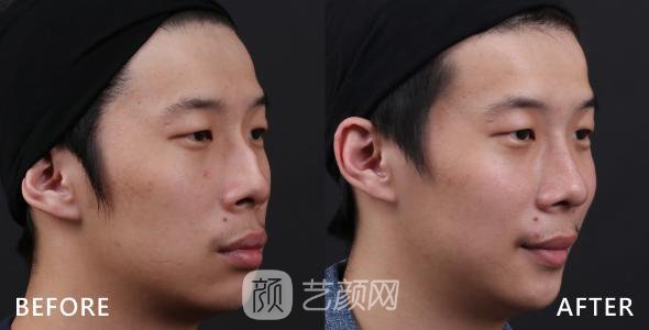 武漢駝峰鼻矯正費(fèi)用大概多少？