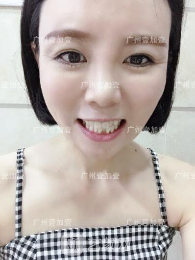 真實齙牙矯正牙齒案例