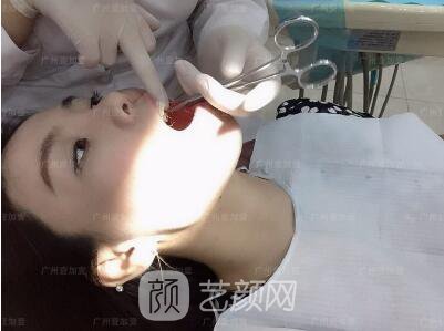 真實齙牙矯正牙齒案例