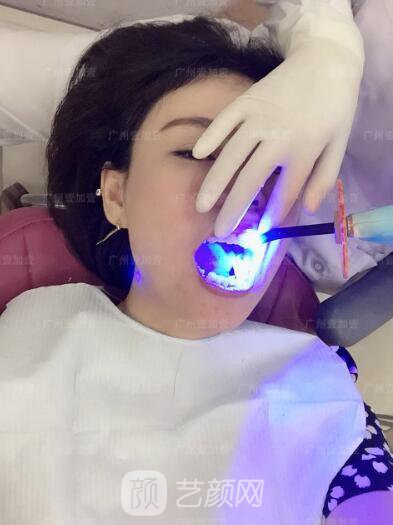 真實齙牙矯正牙齒案例