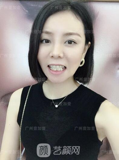 真實齙牙矯正牙齒案例